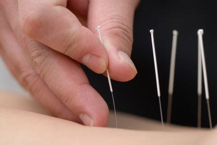 Fine Acupuncture needles being used on a patient